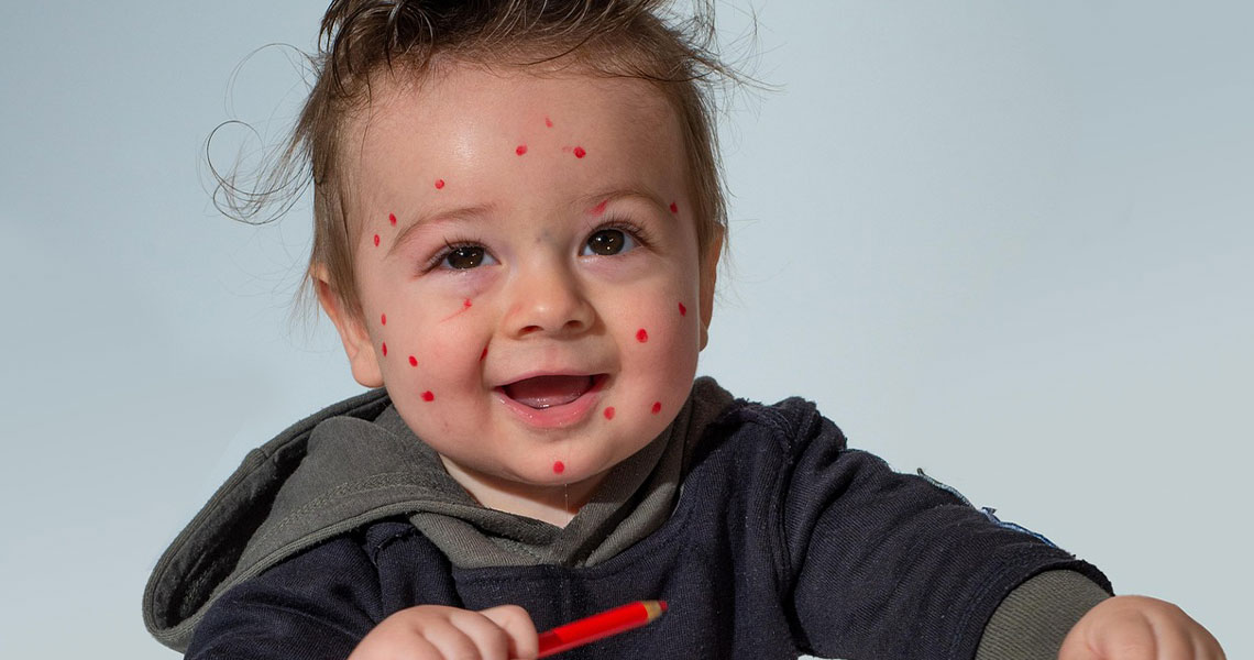 Chickenpox (Varicella): Causes, Symptoms, Treatment, and Prevention